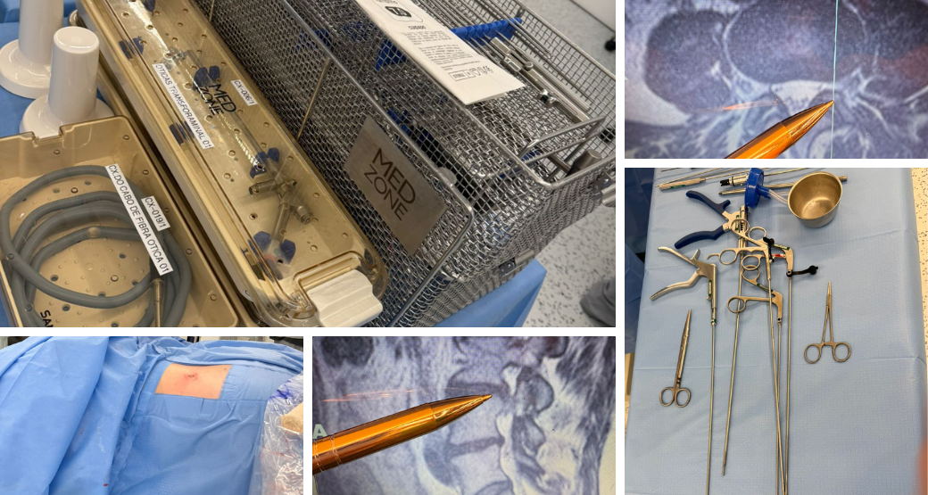 Cirurgia endoscópica transforaminal: Menos dor e recuperação rápida Cirurgia endoscópica transforaminal: Menos dor e recuperação rápida