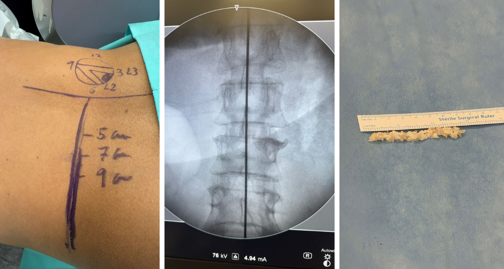 Sofre com hérnia de disco extra-foraminal?