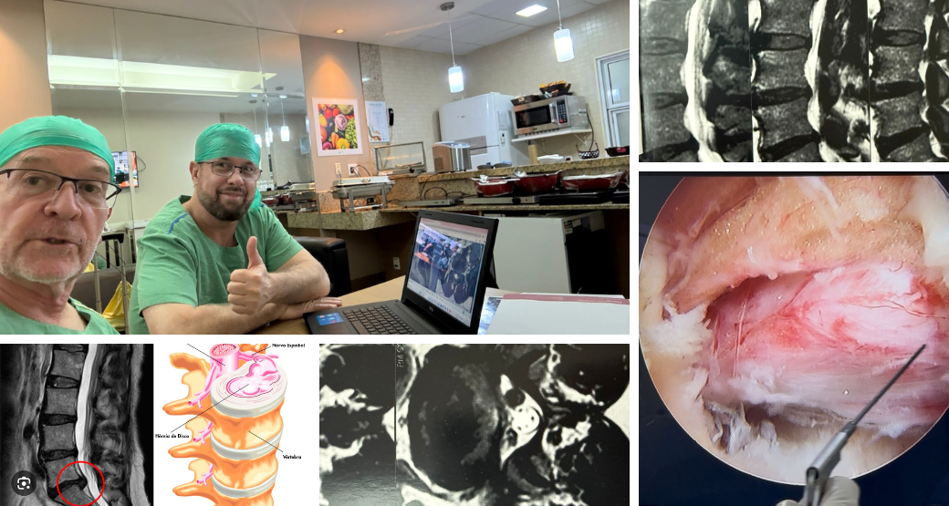 A solução para a hérnia calcificada está mais perto do que você imagina