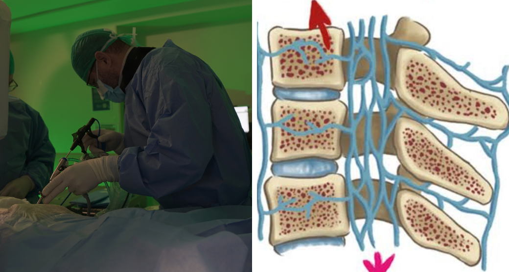 Hérnia Discal: Como a descompressão endoscópica pode mudar a sua vida
