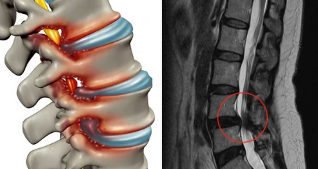 Tratamento da Estenose: Opções e Perspectivas