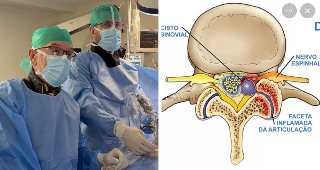 Descompressão Endoscópica Interlaminar: Solução para o cisco sinovial facetário?