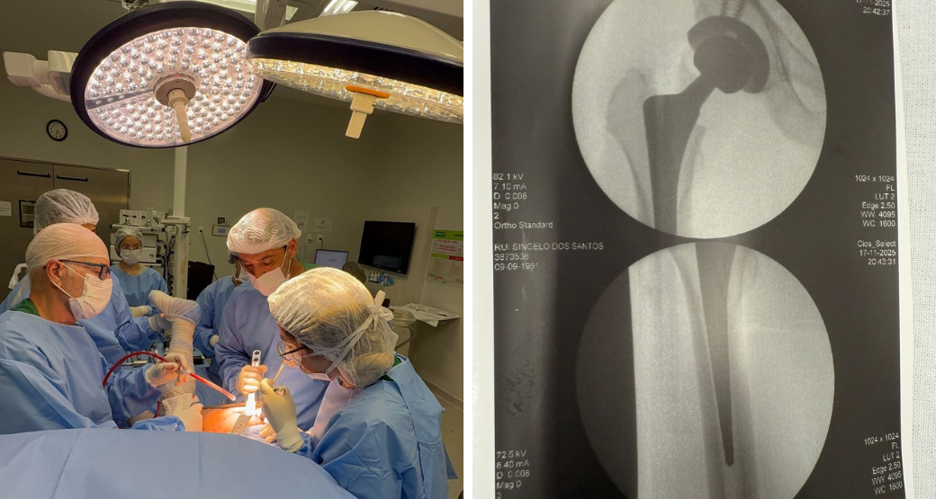 Artroplastia total de quadril não cimentada, com cabeça cerâmica: Conheça as vantagens