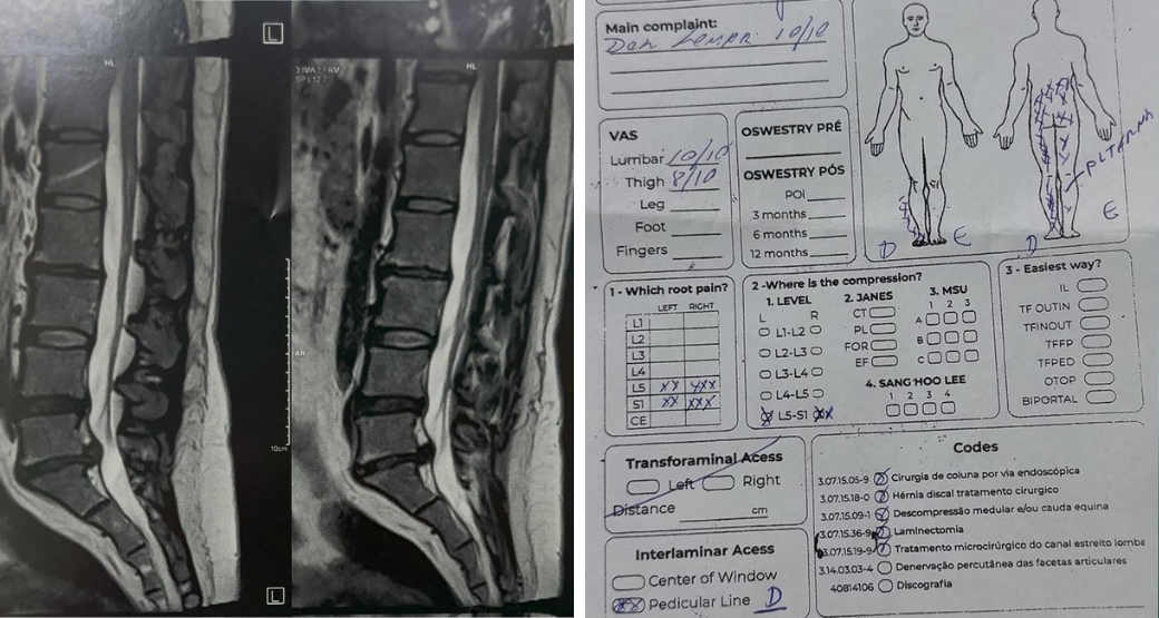 Dor lombar que irradia para as pernas? Pode ser Radiculopatia Lombossacra
