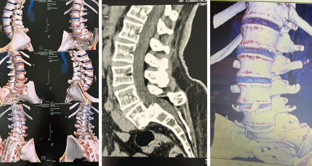 Cirurgia endoscópica transforma vida de paciente idosa com dor crônica e defeito congênito