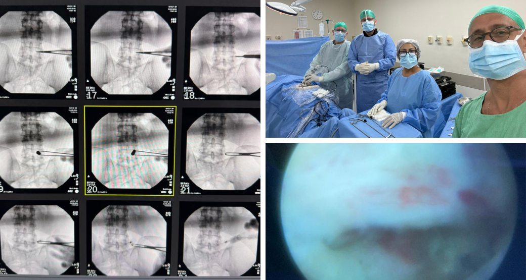 Estenose no canal lombar? Cirurgia endoscópica com menos dor e recuperação rápida