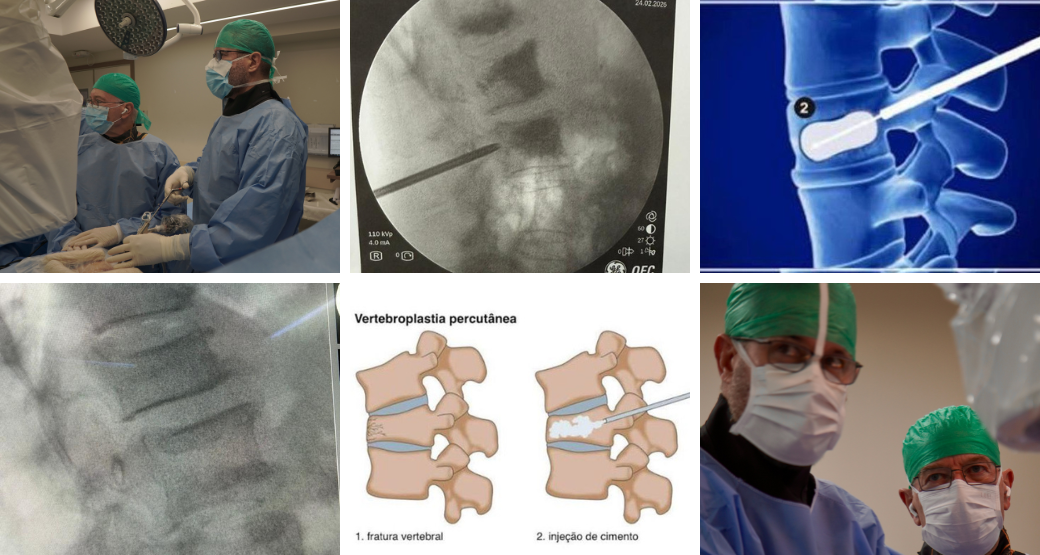 Fratura vertebral osteoporótica: uma das complicações mais comuns da Osteoporose