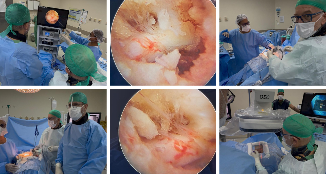 Hérnia Discal Extraforaminal na Raiz L4. Entenda a compressão nervosa e o tratamento