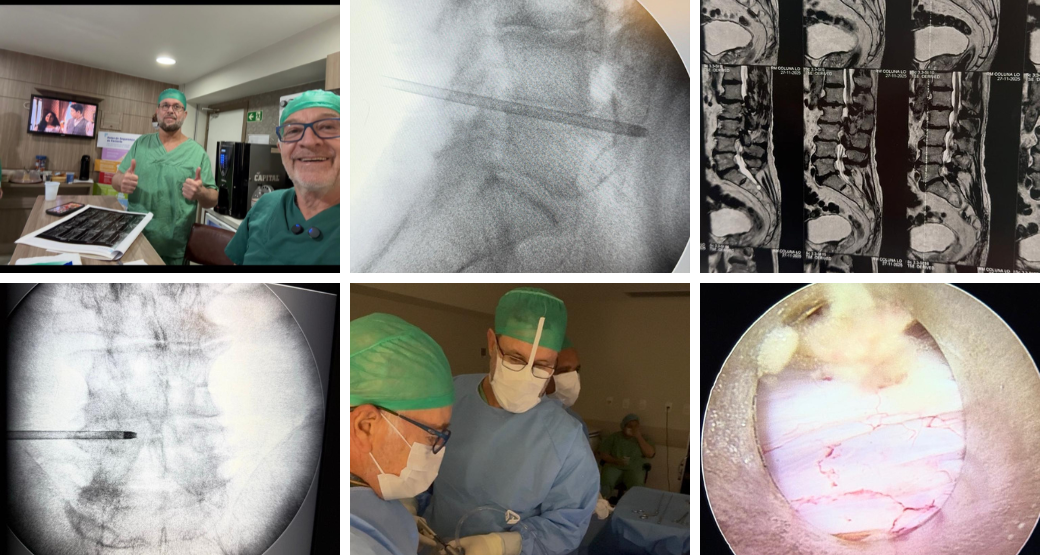 Dor nas costas e pernas? Estenose lombar em múltiplos níveis pode ser a causa