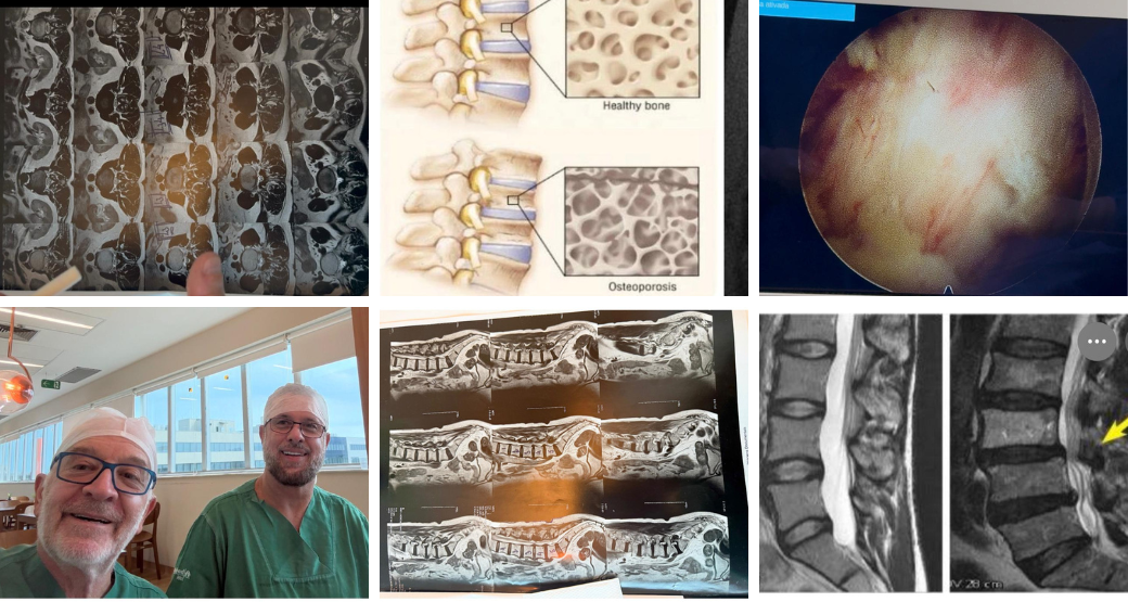 Estenose lombar avançada: Solução para múltiplos níveis de compressão