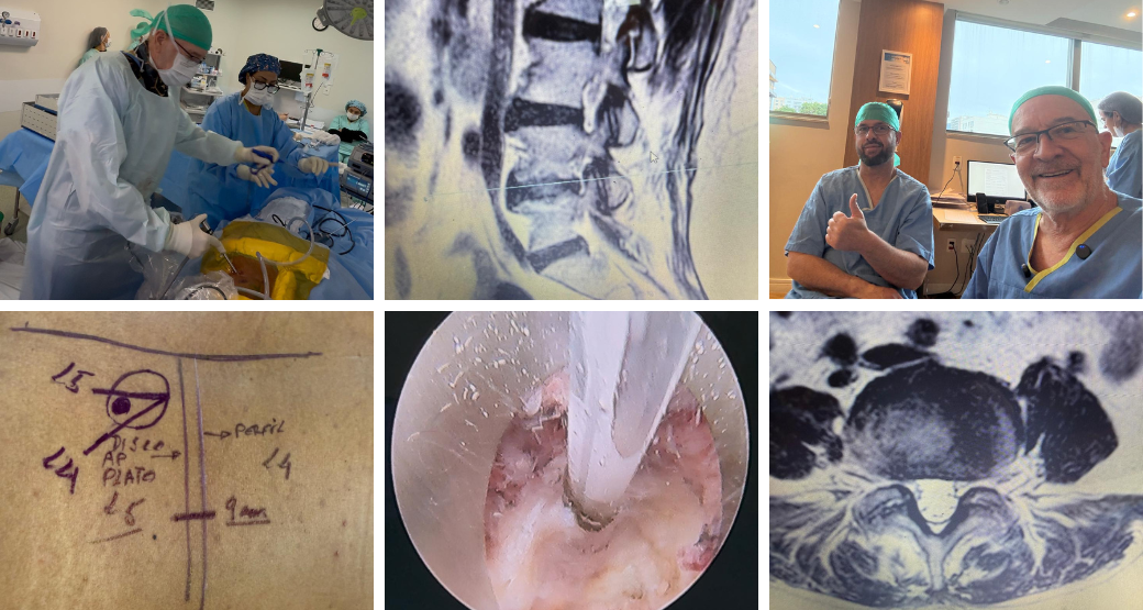 Como remover hérnia discal extraforaminal para aliviar a dor e a compressão