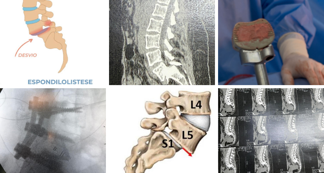 Movimento é vida: Cirurgiões da Orto Center tem soluções para espondilolistese ístmica grau IV em pacientes jovens