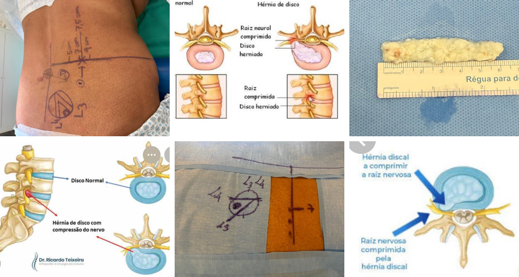 Compressão radicular: alívio rápido com cirurgia endoscópica