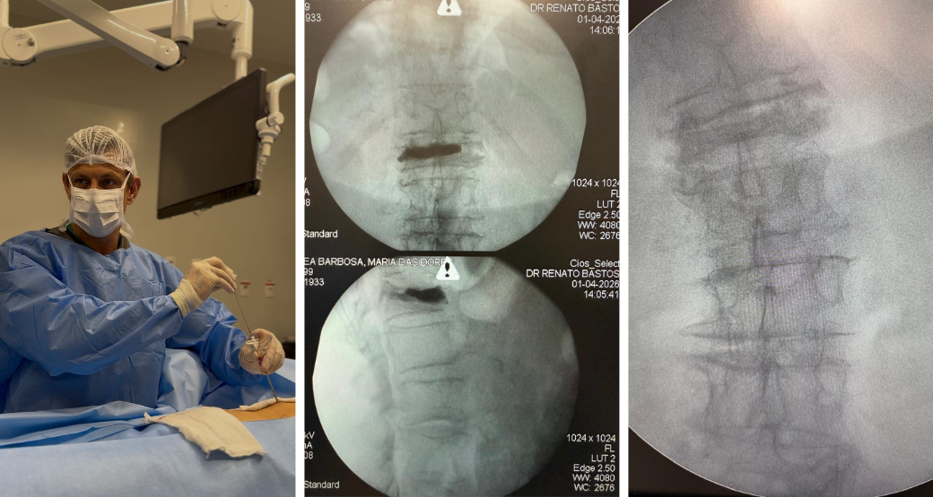 92 anos de força: Tratamentos avançados e minimamente invasivos para fratura vertebral