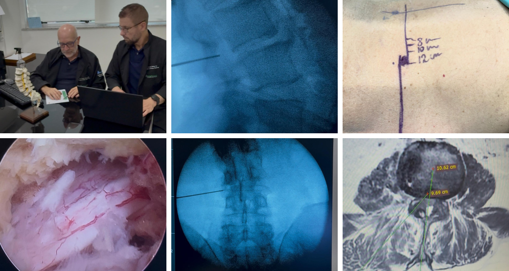 Estenose lombar extensa e multissegmentar: prioridades para um tratamento eficaz e seguro