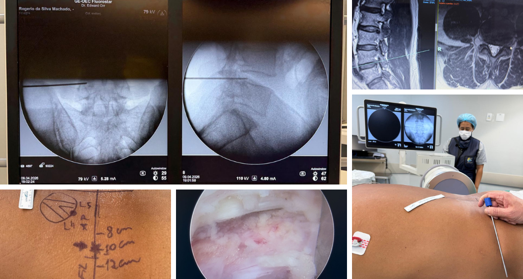 Raízes L4 e L5 em foco: Saiba mais sobre tratamento avançado para hérnia de disco e estenose