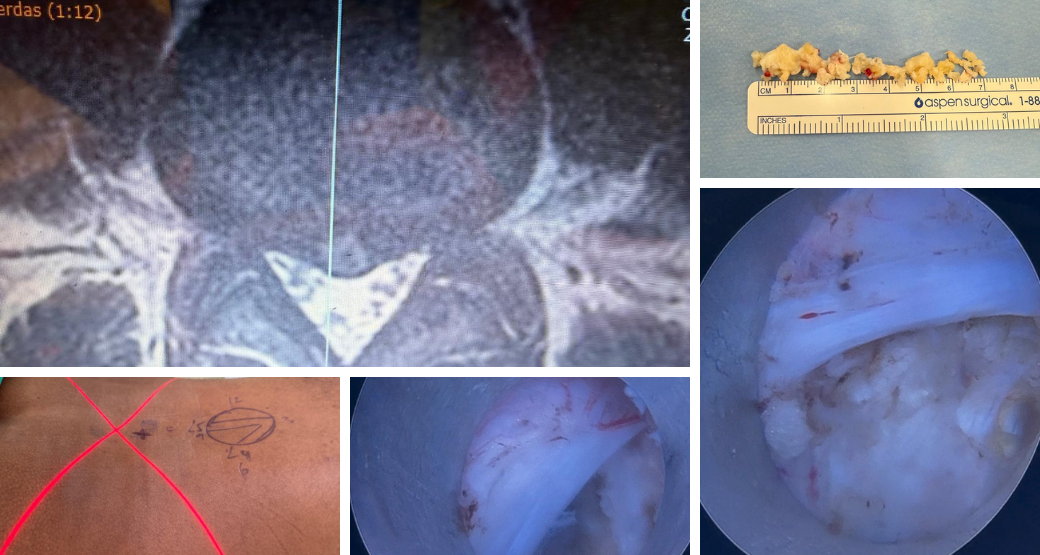 Descompressão endoscópica: Alívio para compressão radicular nas raízes L4 e L5?