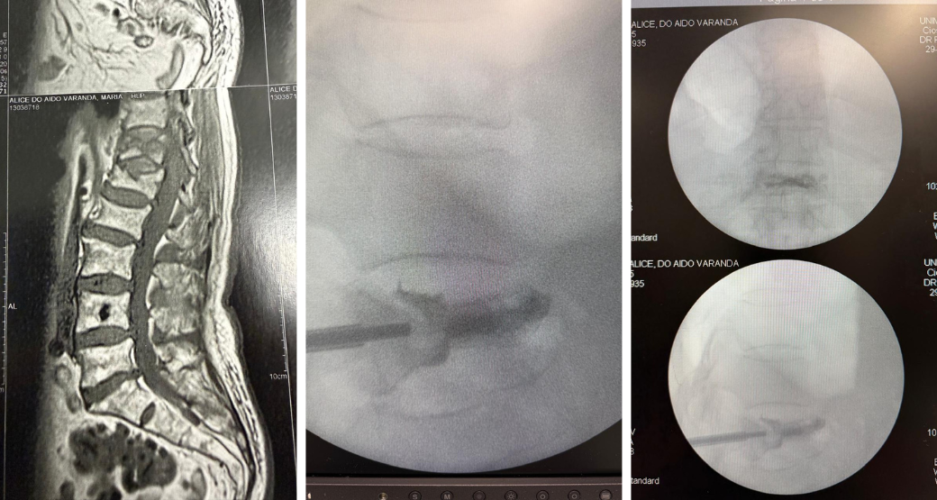 Estabilização vertebral: Cifoplastia devolve sustentação a coluna