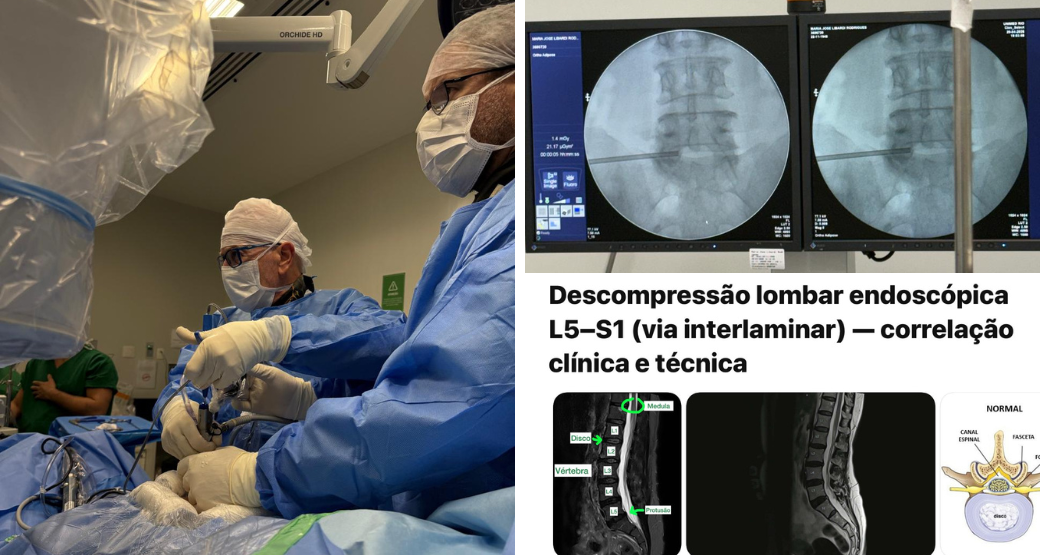 Caso complexo aos 76: cirurgia endoscópica descomprime as raízes L5 e S1