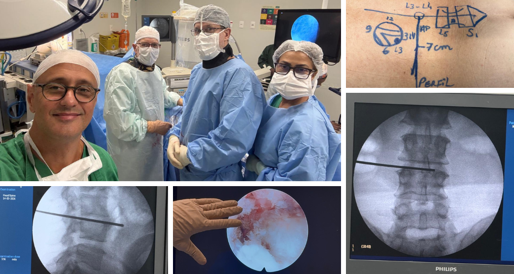 Por que fazer uma cirurgia grande se a endoscopia resolve duas hérnias? Caso real, 58 anos