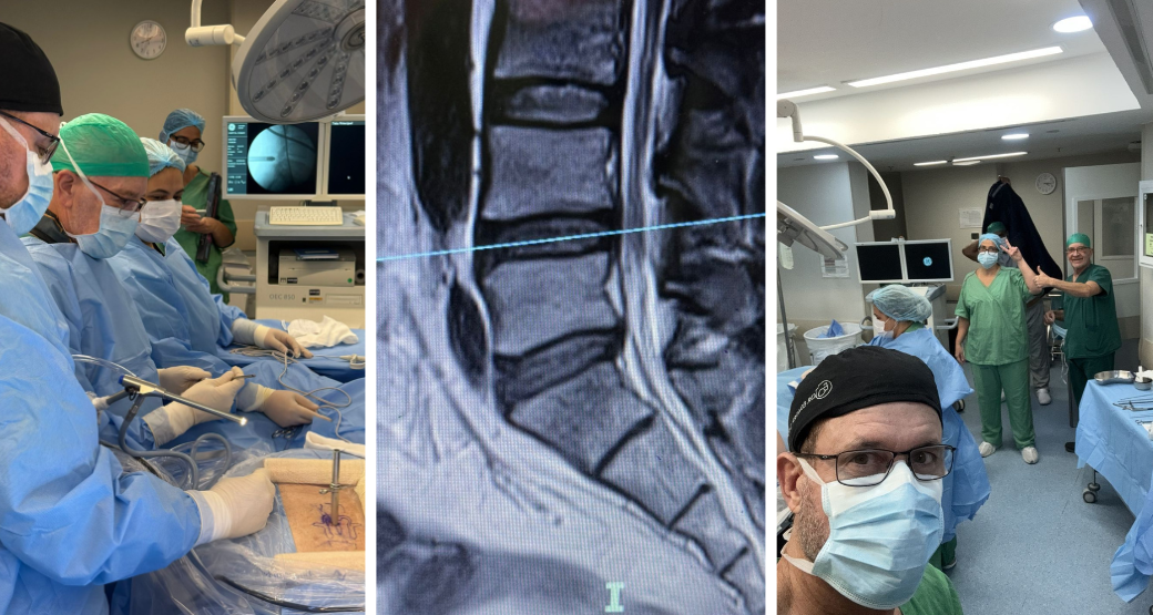 Raiz L5 travada a direita e hérnias multiníveis. Endoscopia interlaminar descomprime tudo