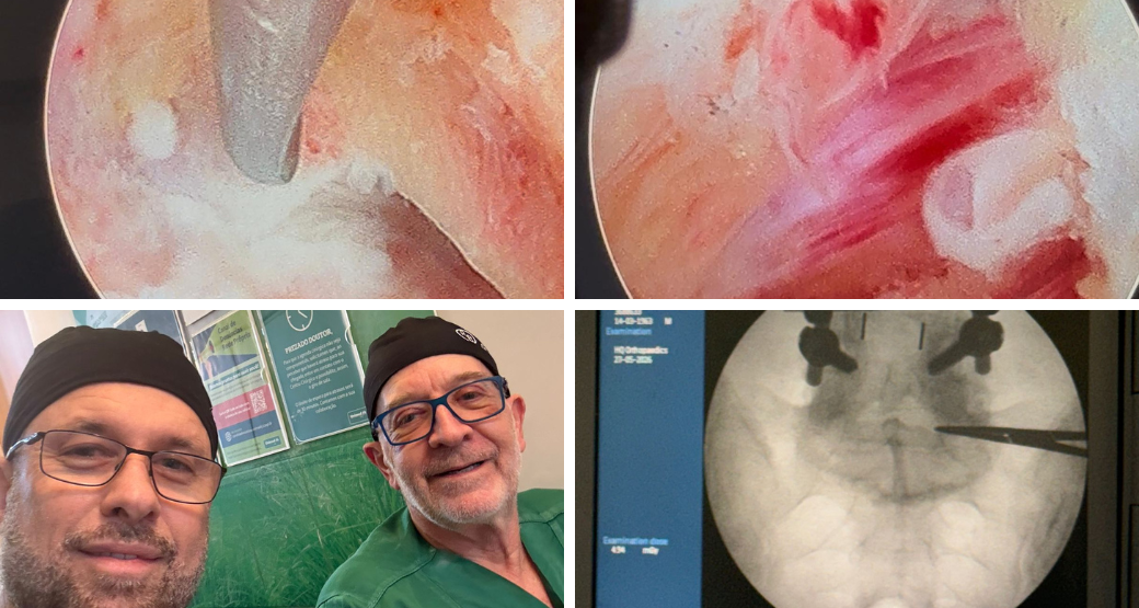 Artrodese prévia não é barreira para Endoscopia. É desafio.