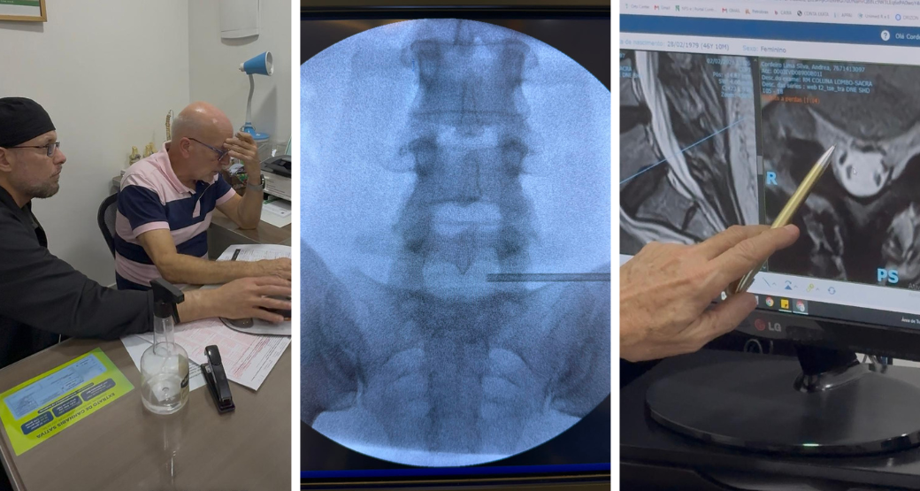 Endoscopia interlaminar descomprime duas hérnias discais lombares