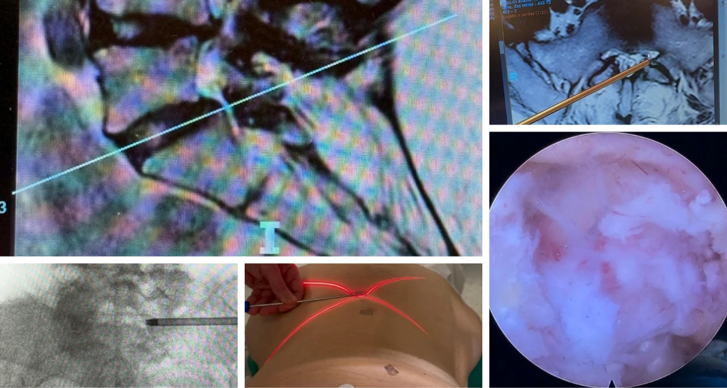 77 anos e venceu a dor pela 3ª vez. Endoscopia de coluna realizada com sucesso
