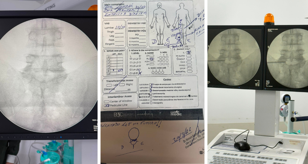 Cirurgia Endoscópica da Coluna: paciente volta a ter qualidade de vida após descompressão das raízes L5 e S1