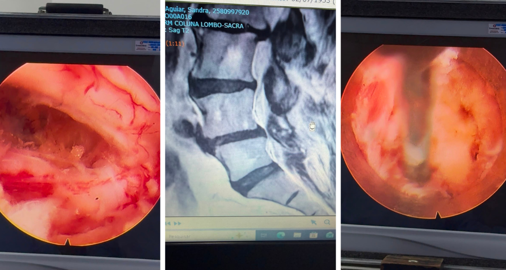 Estenose do Canal Lombar: como a Endoscopia da Coluna devolveu qualidade de vida a uma paciente de 73 anos
