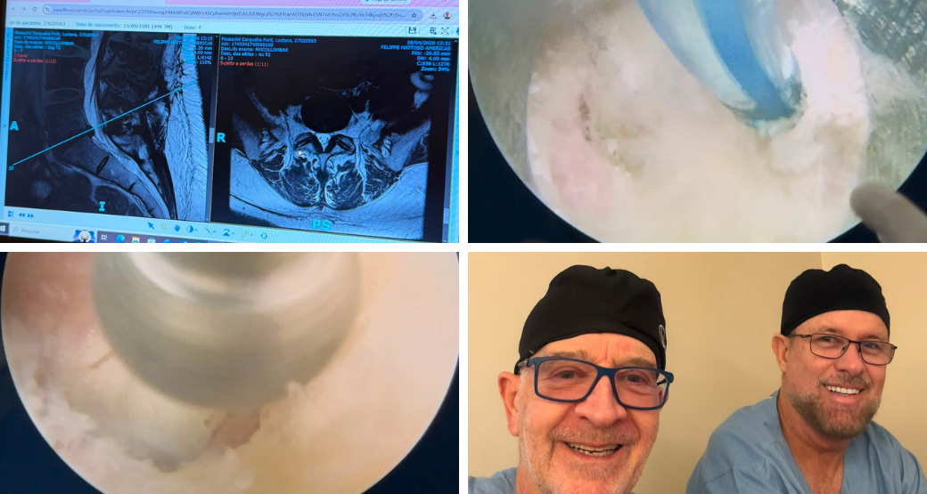 Quando a hérnia migra a solução é a Endoscopia