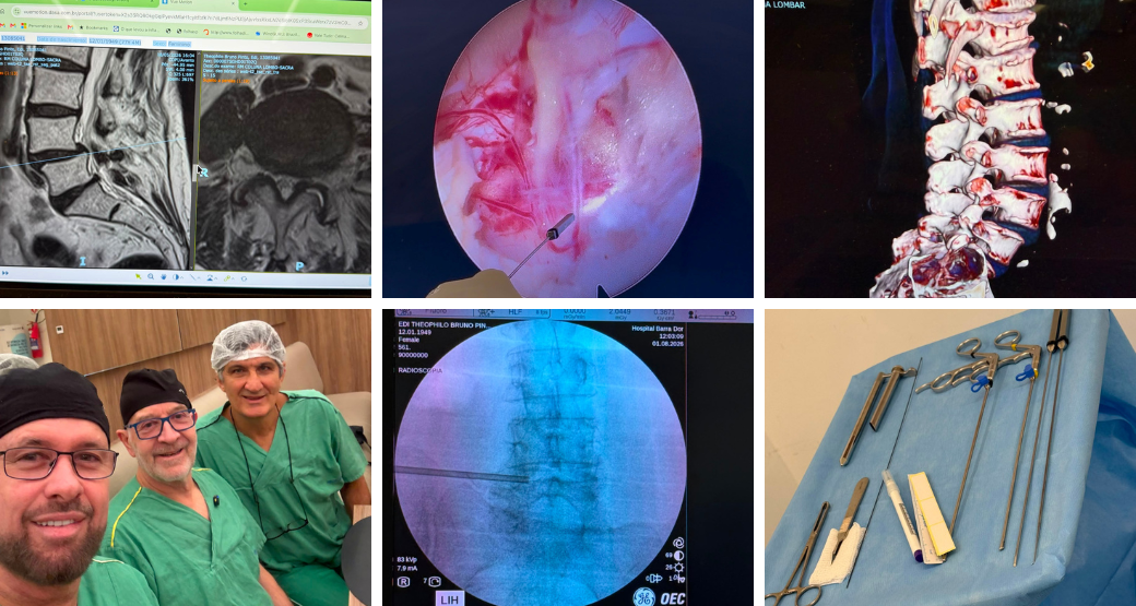 OrtoCenter: referência em cirurgia endoscópica da coluna