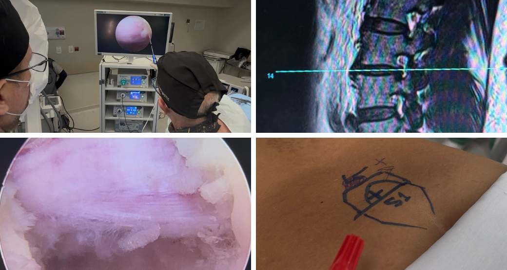 Paciente idoso com várias hérnias na lombar. Solução? Cirurgia endoscópica